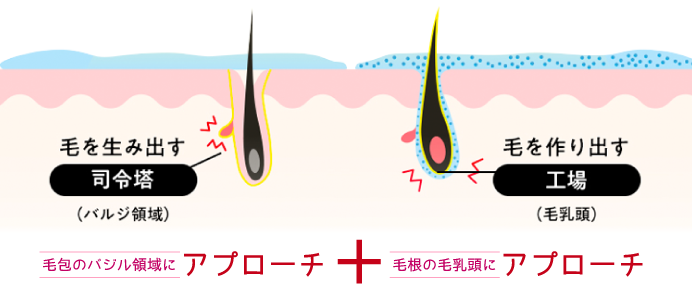 ハイブリット脱毛